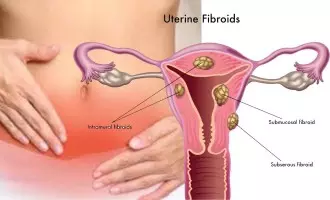 Dr Nutan Jain for Uterine Fibroid Treatment. Best Hospital for Uterine Fibroids in India, Best Doctor for treatment of Uterine Fibroids in Muzaffarnagar, Treatment of Uterine Fibroids without surgery in India,  Uterine Fibroid Treatment in Uttar Pradesh India